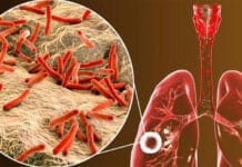 Aumentaron un 38% los casos de tuberculosis en Argentina